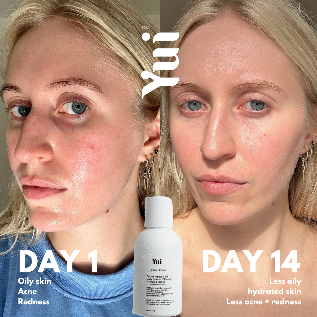 Before and after using Yui cleanser for 14 days, showing reduced oiliness, redness, and improved hydration on sensitive skin.