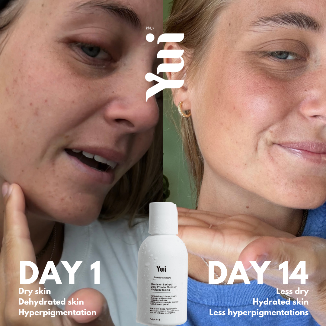 Yui Skin powder face cleanser results after 14 days showing improved hydration and reduced hyperpigmentation on dry, sensitive skin.