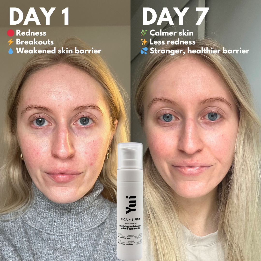 Before and after 7-day results using Yui Skin moisturizer, showing reduced redness and stronger skin barrier on sensitive skin.
