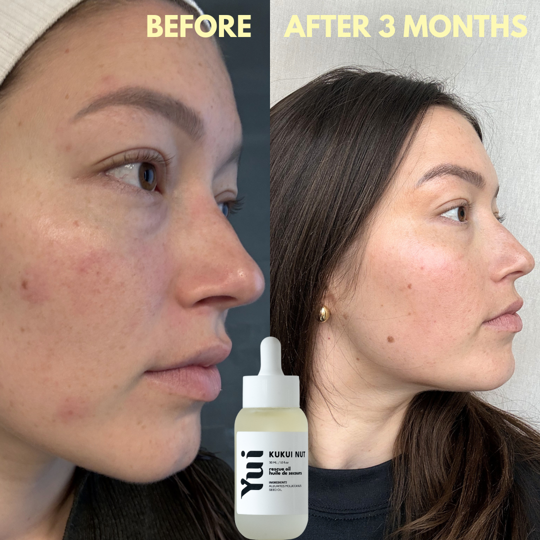 Three-month transformation using Yui Skin Kukui Nut Oil from the Discovery Kit, showing clearer, smoother skin with reduced blemishes.
